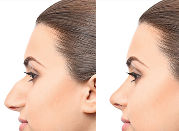 Noyan Health & Travel | Nose Aesthetics | 1