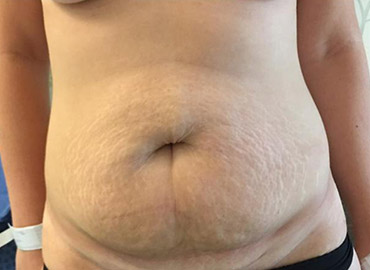 Noyan Health & Travel | Abdominoplasty | 1