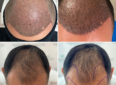 Noyan Health & Travel | Hair Transplant | 3