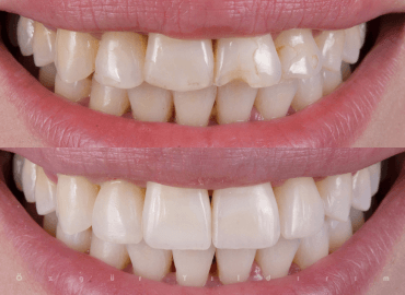 Noyan Health & Travel | Dental Treatments | 14