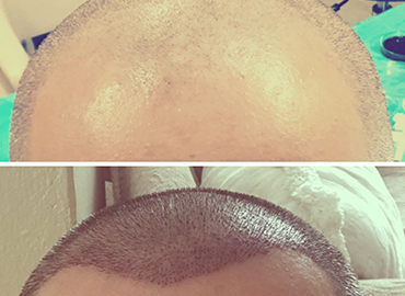 Noyan Health & Travel | Hair Transplant