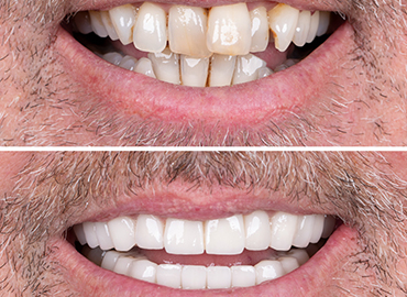 Noyan Health & Travel | Dental Treatments | 3