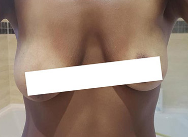 Noyan Health & Travel | Breast Reduction | 1