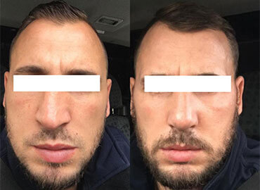 Noyan Health & Travel | Rhinoplasty  | 1