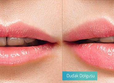 Noyan Health & Travel | Lip Filler | 1