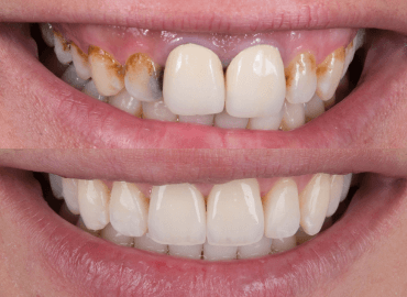 Noyan Health & Travel | Dental Treatments | 19