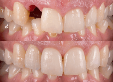 Noyan Health & Travel | Dental Treatments | 12