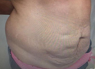 Noyan Health & Travel | Abdominoplasty | 3