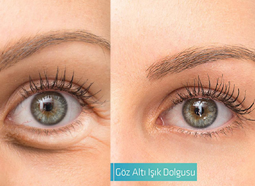 Noyan Health & Travel | Under Eye Light Filler | 1